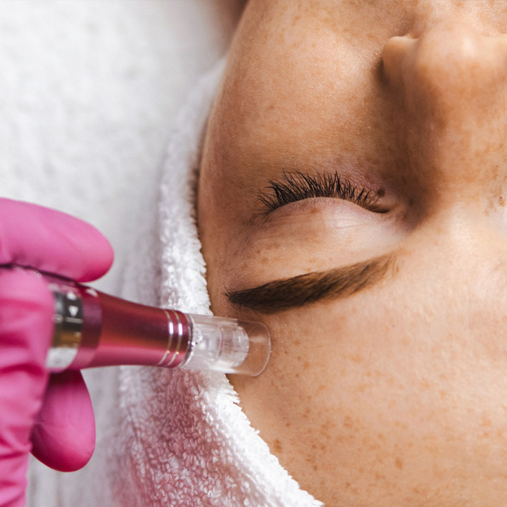 dermapen microneedling facial forehead