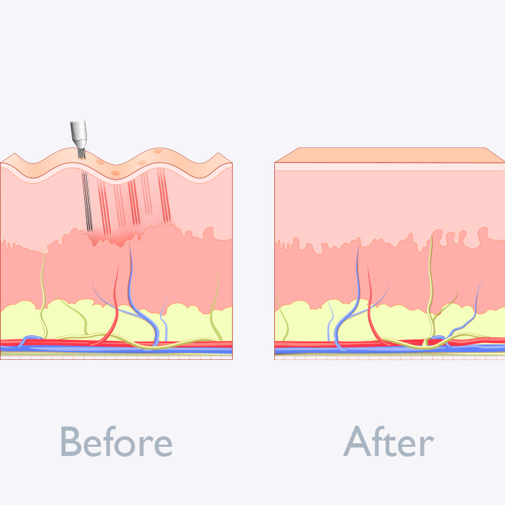 microneedling skin illustration before after