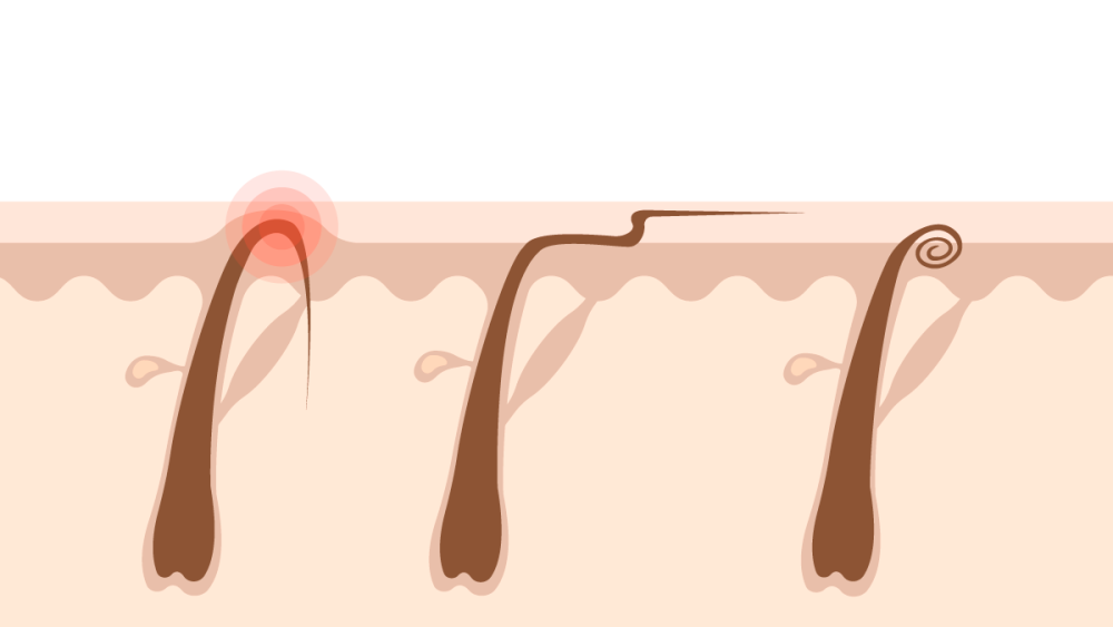 ingrown hairs types illustration