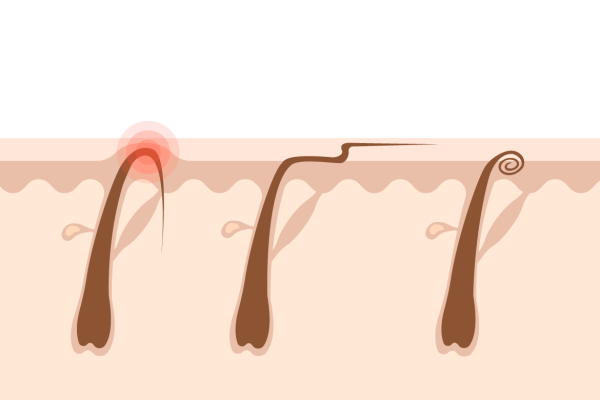 ingrown hairs types illustration