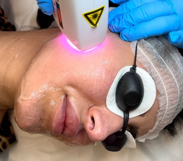 Facial hair laser removal