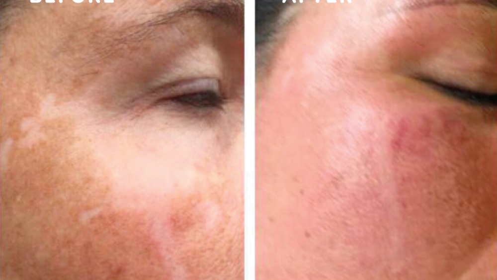 Before and after dpm8 for hyperpigmentation