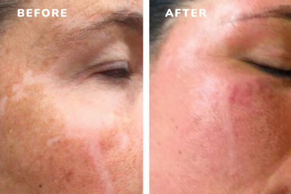 Before and after dpm8 for hyperpigmentation