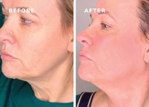 Using dpm8 for skin tightening