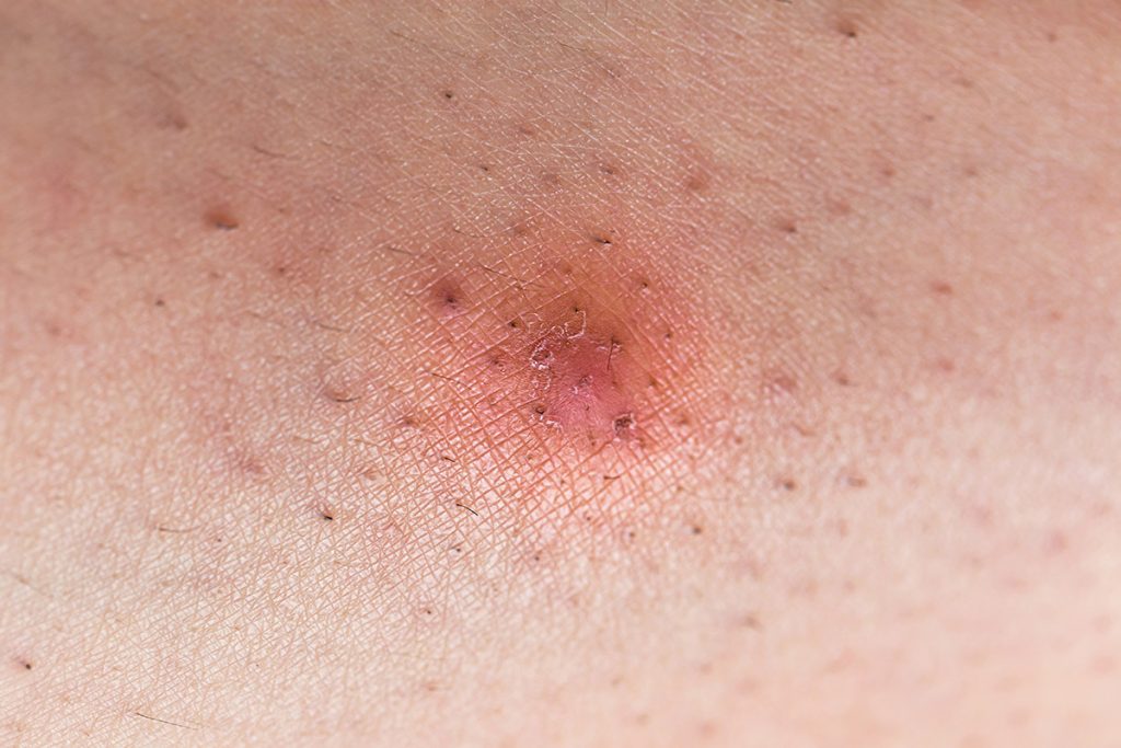 ingrown hair on legs