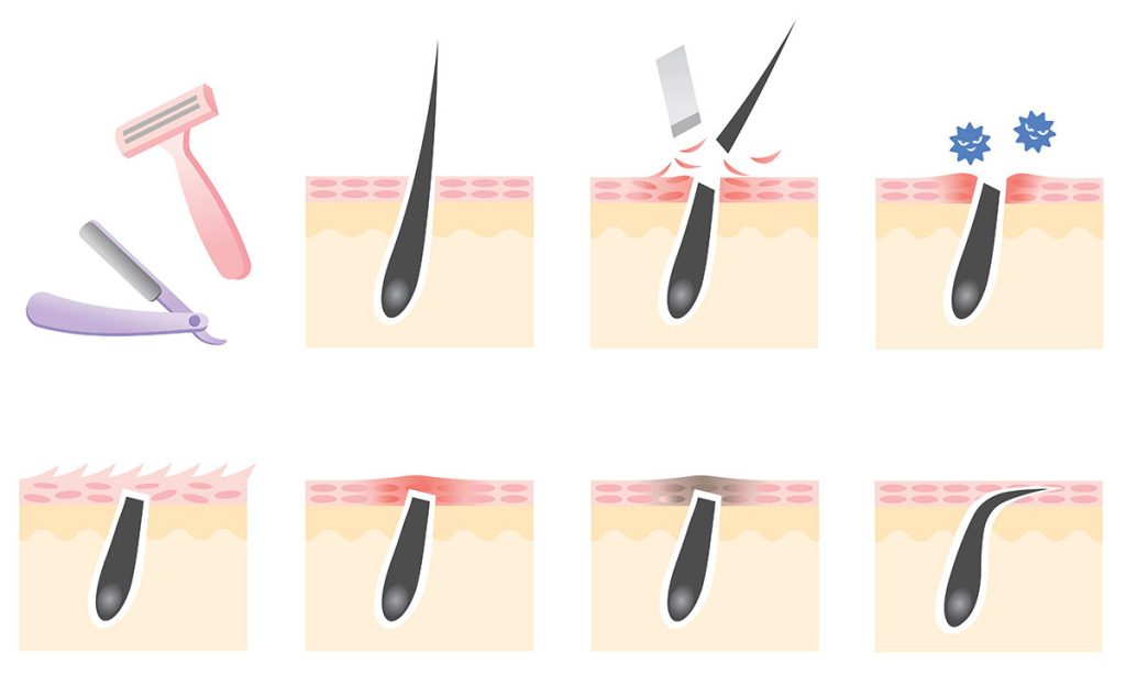 Ingrown hairs illustration