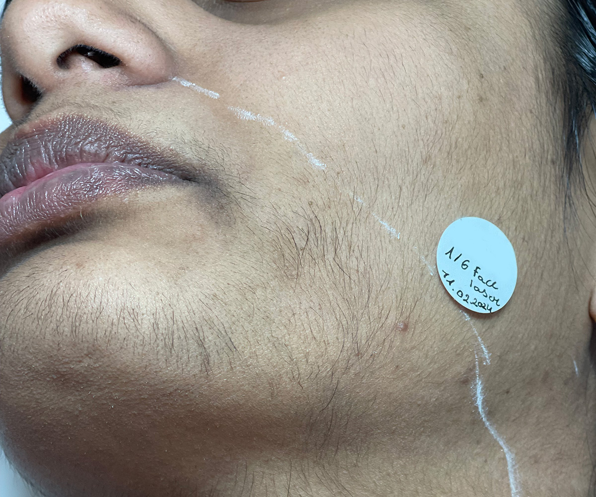 before 1st laser hair removal session on face and neck