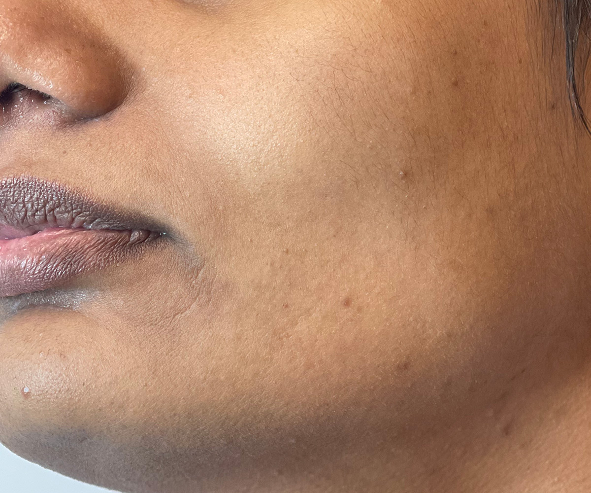 after laser hair removal session on face and neck