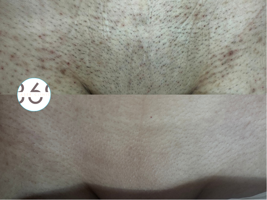 369-laser-hair-removal-bikini-birmingham-clinic-real-story hair removal bikini birmingham clinic real story