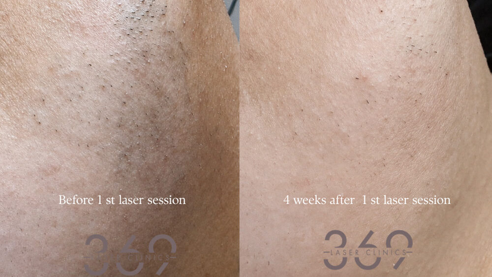 PCOS laser hair removal 369 client featured before after