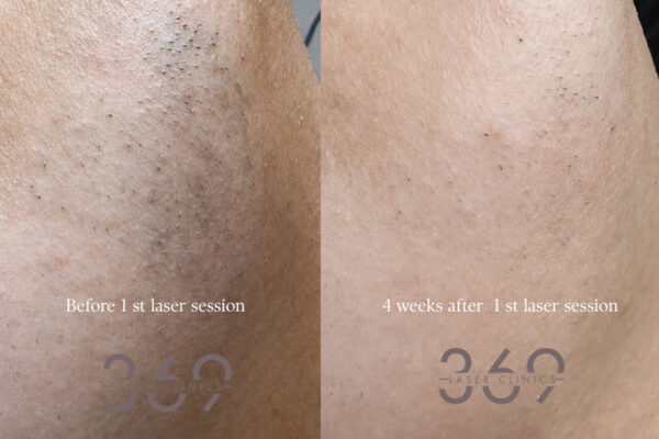 PCOS laser hair removal 369 client featured before after