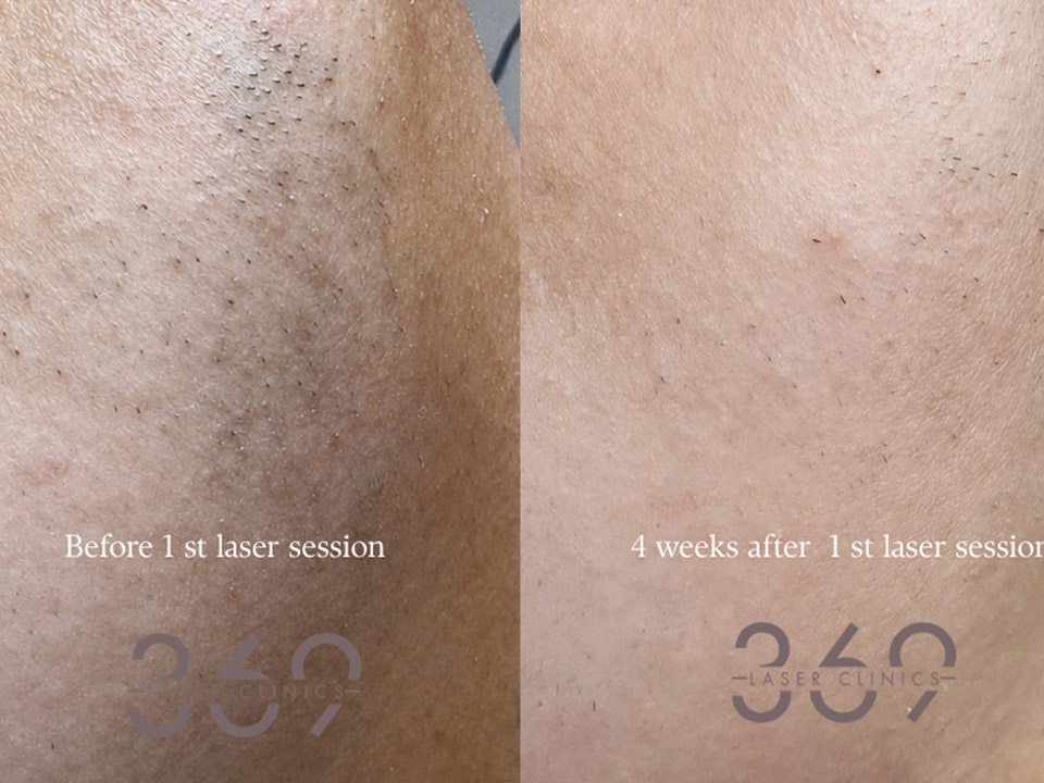 PCOS Hair Removal Diode Cooling Laser