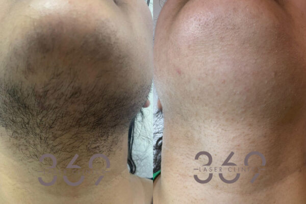 laser hair removal mans beard 369LC birmingham