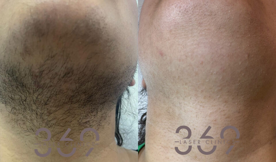 laser hair removal mans beard 369LC birmingham