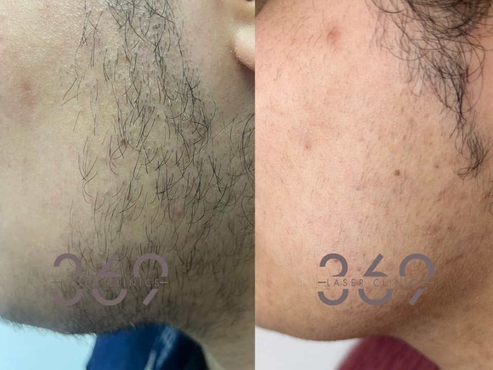 laser-hair-removal-mans-beard-side-369LC-birmingham laser hair removal mans beard side 369LC birmingham