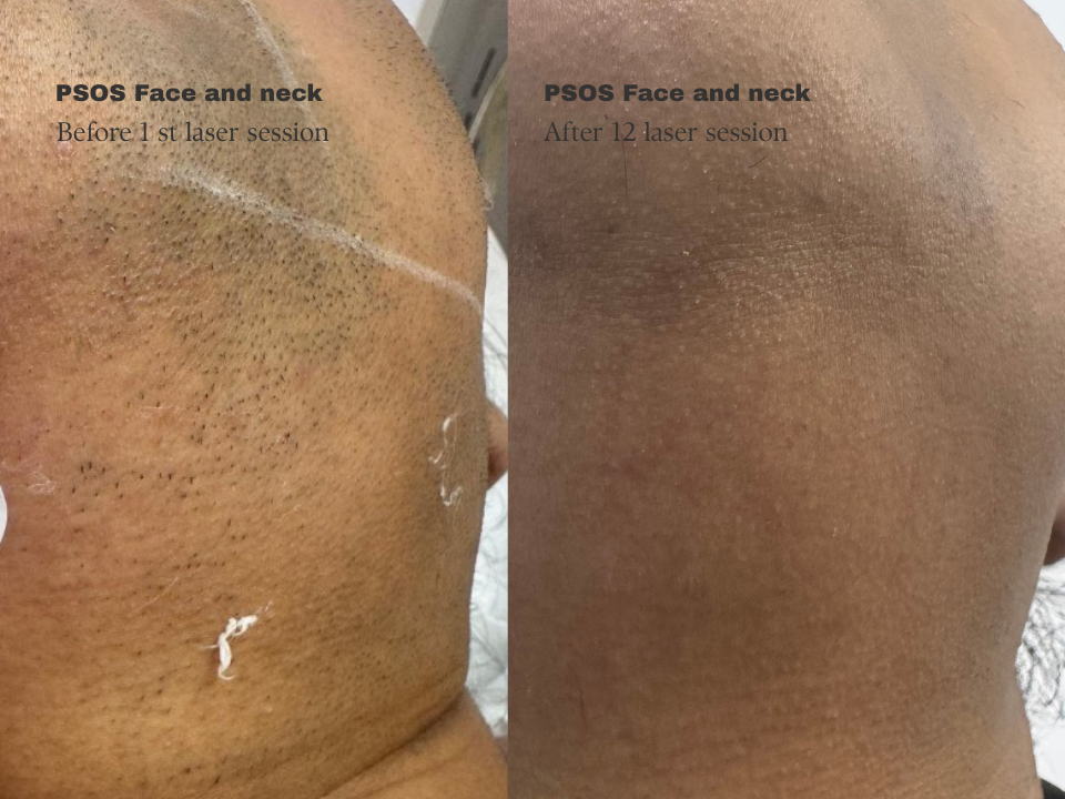 PCOS face & neck laser hair removal