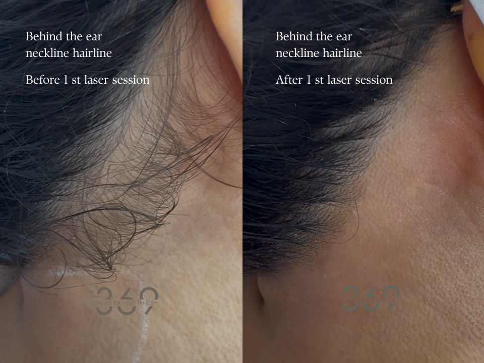 Neck Hairline Laser Hair Removal