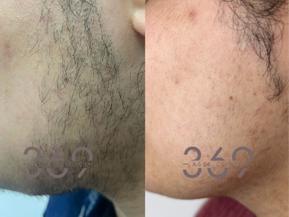 Mens Beard Laser Hair Removal