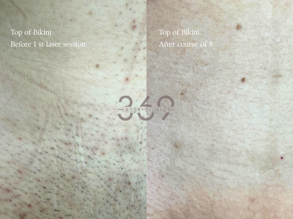 Top Bikini Laser Hair Removal 8 Sessions