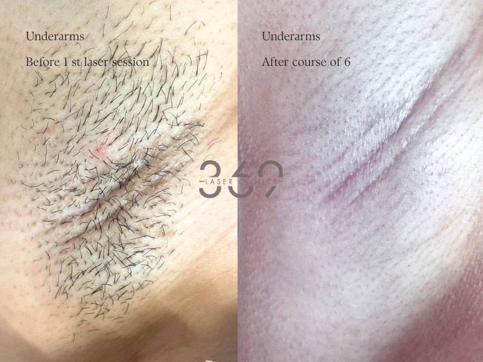 Laser Hair Removal Underarms
